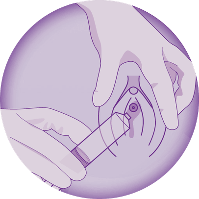 Icon showing application of gel to the female urethra